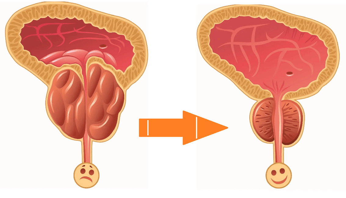 Uromexil Forte ietekme uz prostatu ar prostatītu un adenomu